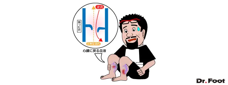 第45回下肢静脈瘤