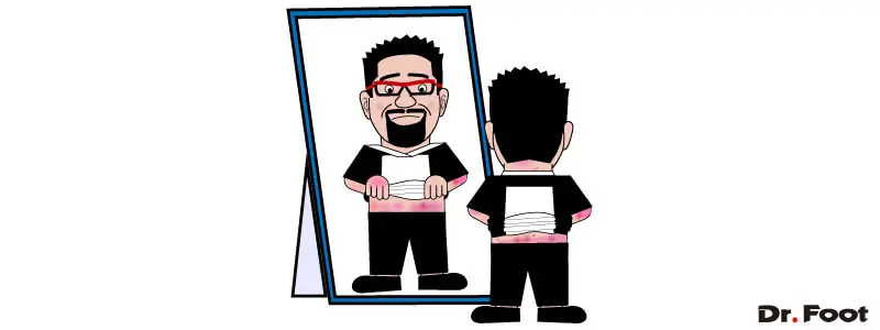 第46回尋常性乾癬