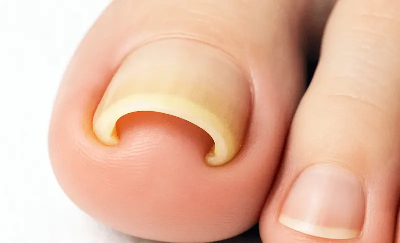 ドクターフットの巻き爪ケア施術イメージ